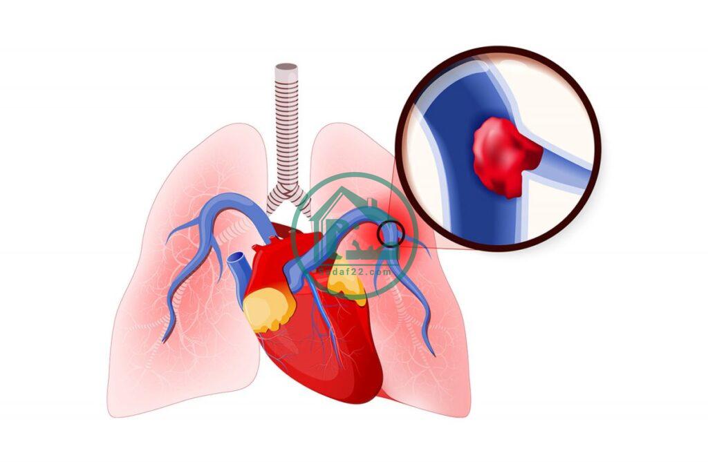 آمبولی ریه چیست ؟ علائم اولیه آمبولی ریه ها